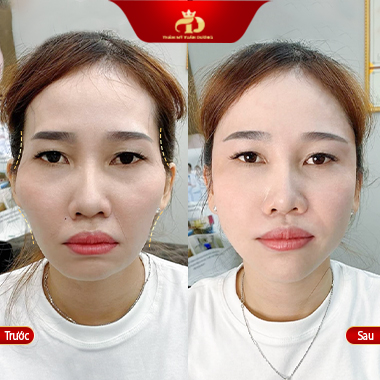 Hạ gò má tại vĩnh phúc