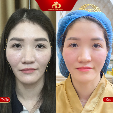 Điều trị má hóp thái dương lõm ở Vĩnh Phúc